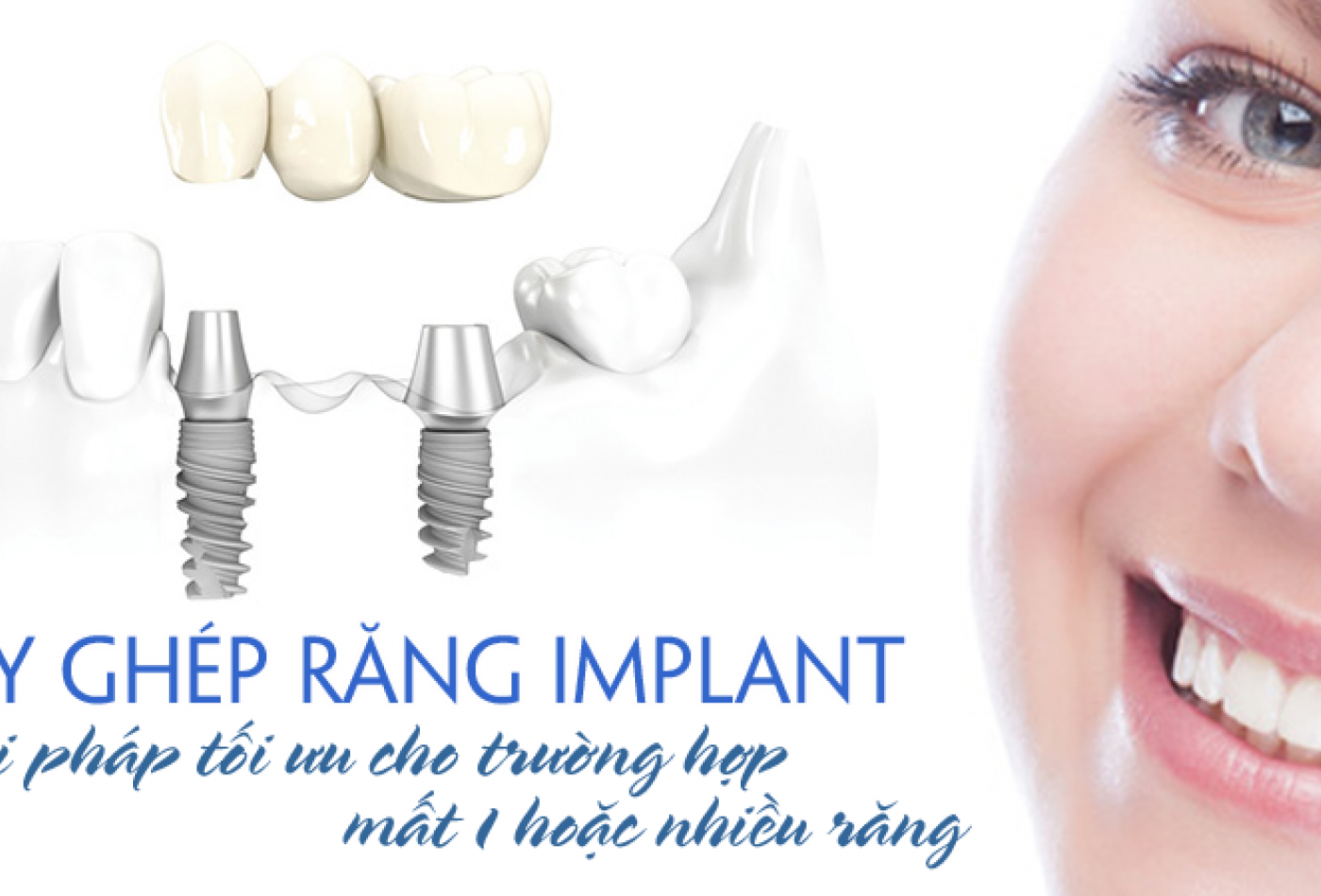 Cấy ghép Implant nha khoa