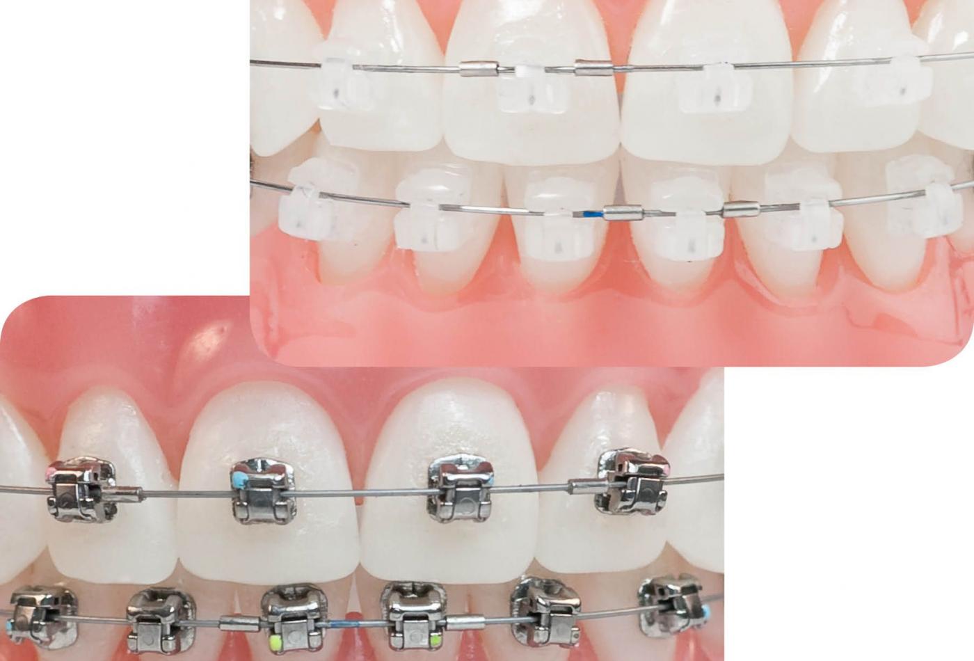 Niềng răng (Chỉnh nha) mắc cài