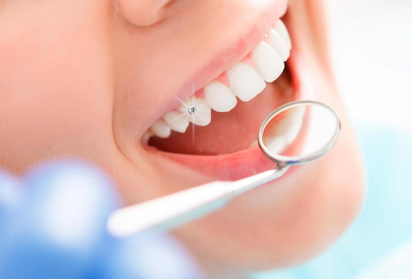 Đính đá trên răng có gây ê buốt không? Những lưu ý khi đính đá trên răng