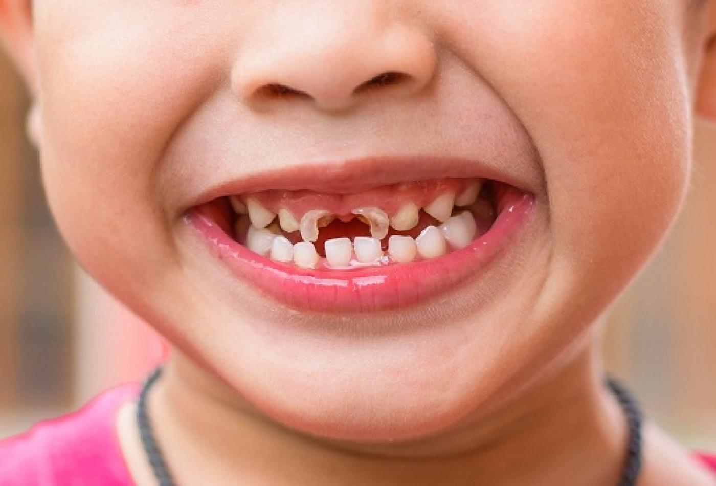 Tại sao các bé 3-4 tuổi lại có tỷ lệ sâu răng cao? nguyên nhân, hậu quả và cách phòng ngừa,chữa trị tình trạng sâu răng cho bé.