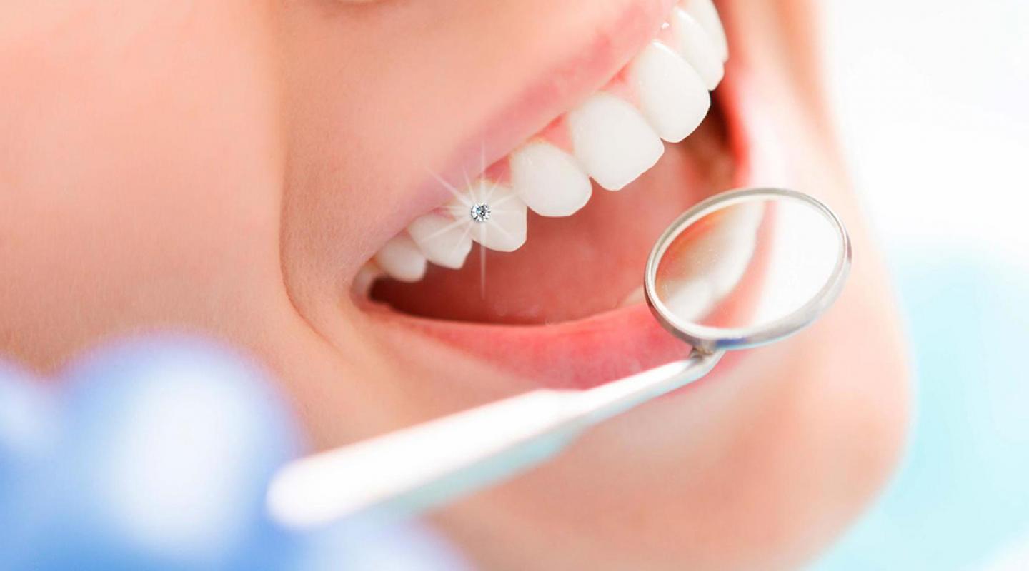 Đính đá trên răng có gây ê buốt không? Những lưu ý khi đính đá trên răng