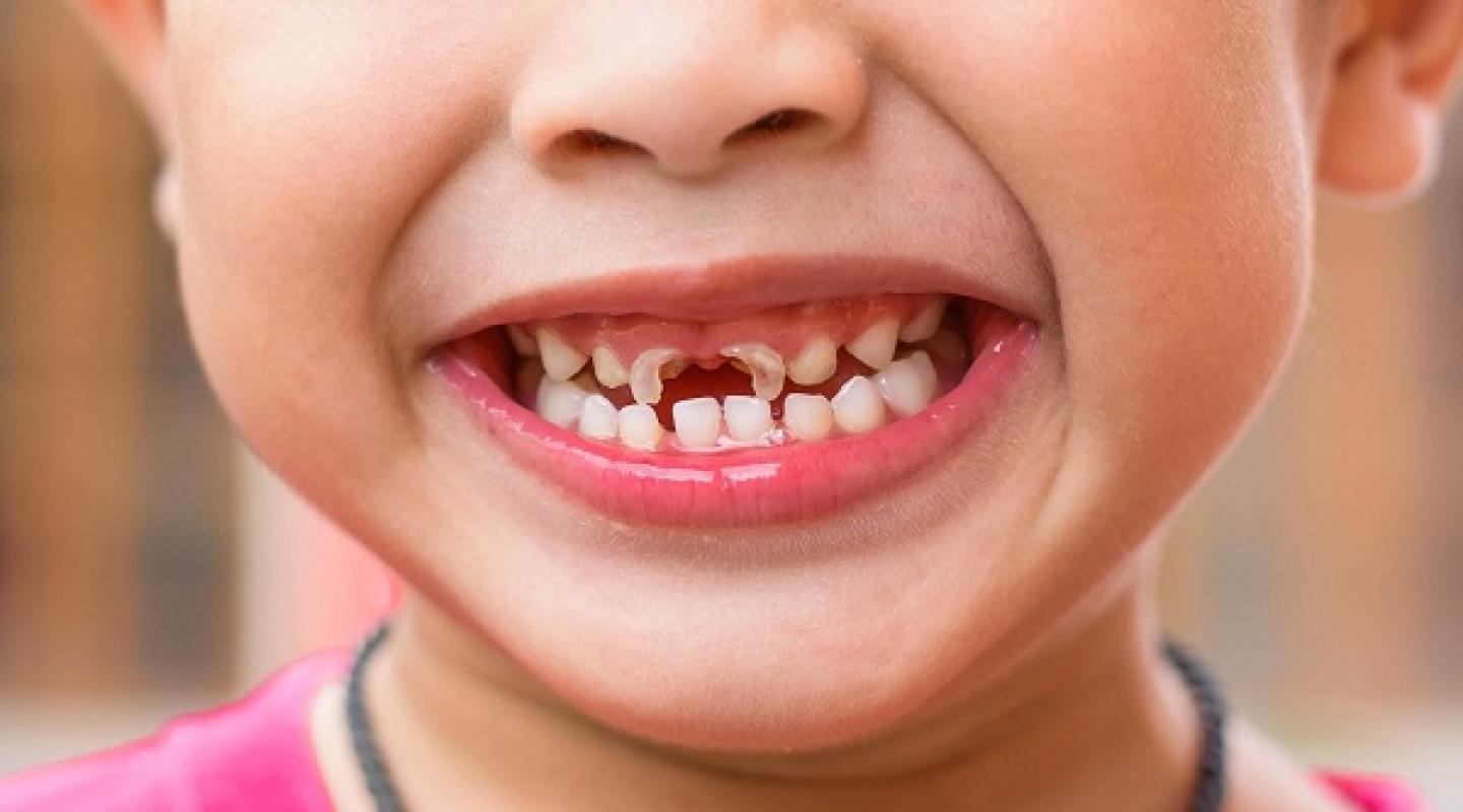 Tại sao các bé 3-4 tuổi lại có tỷ lệ sâu răng cao? nguyên nhân, hậu quả và cách phòng ngừa,chữa trị tình trạng sâu răng cho bé.