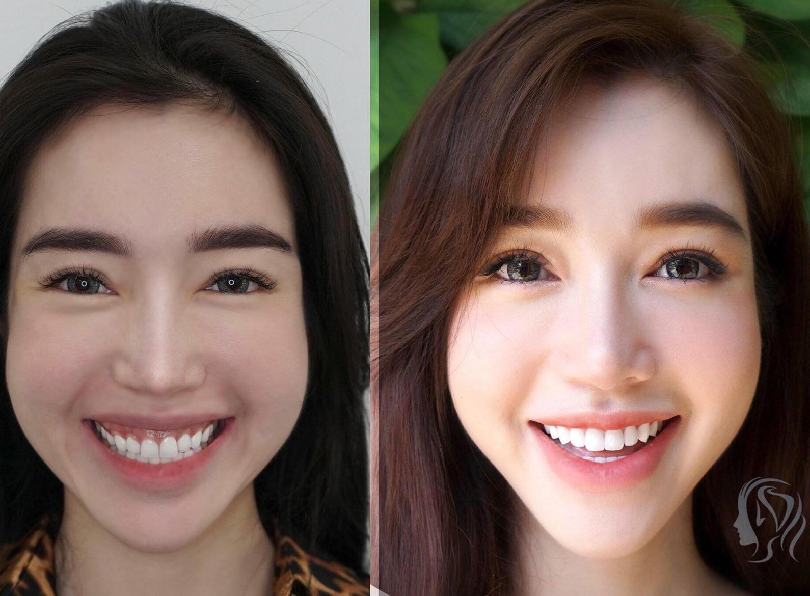 Thẩm mỹ cười hở lợi