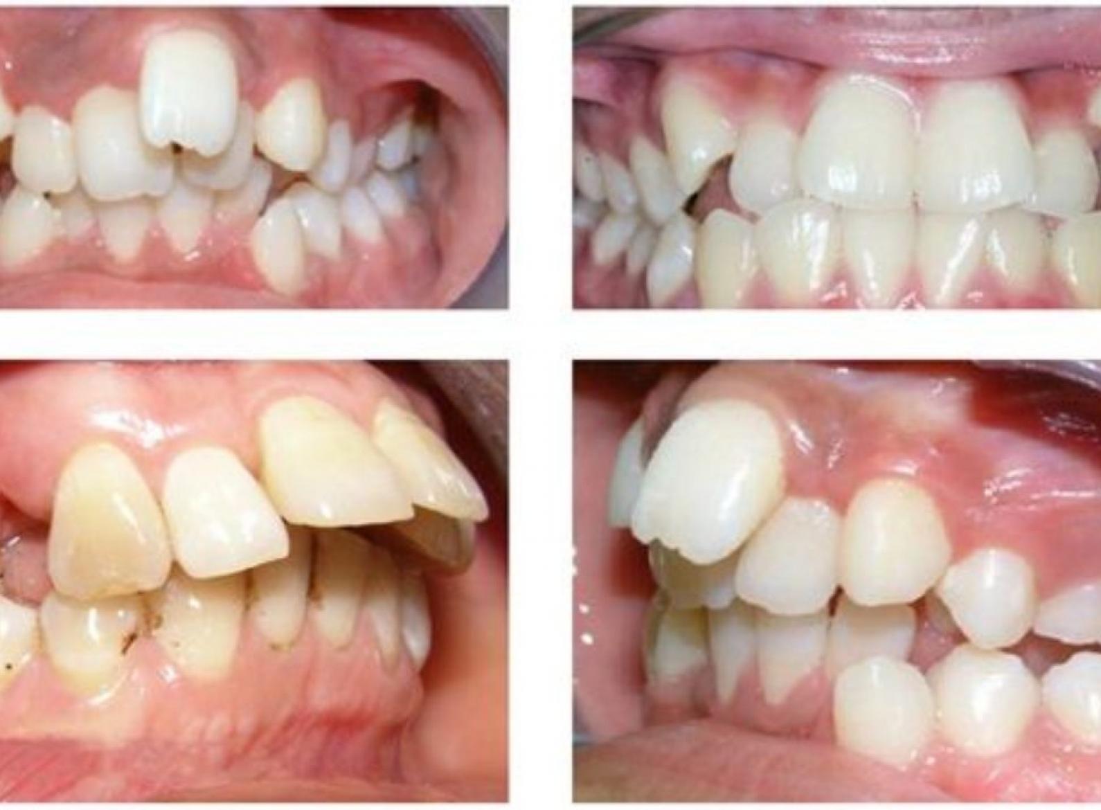 Xử lý răng mọc sai vị trí ở Hải Phòng bằng cách nào?