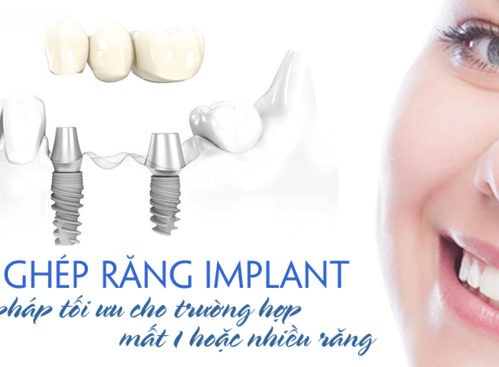 Cấy ghép Implant nha khoa