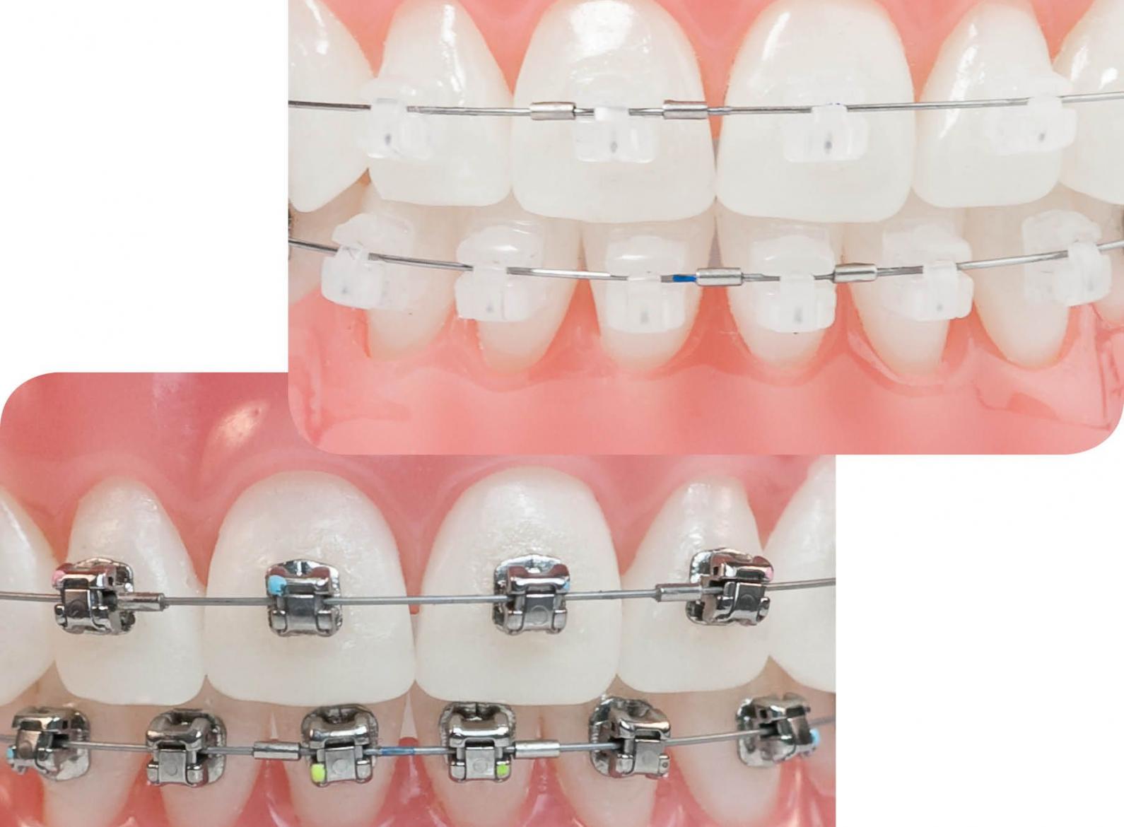 Niềng răng (Chỉnh nha) mắc cài