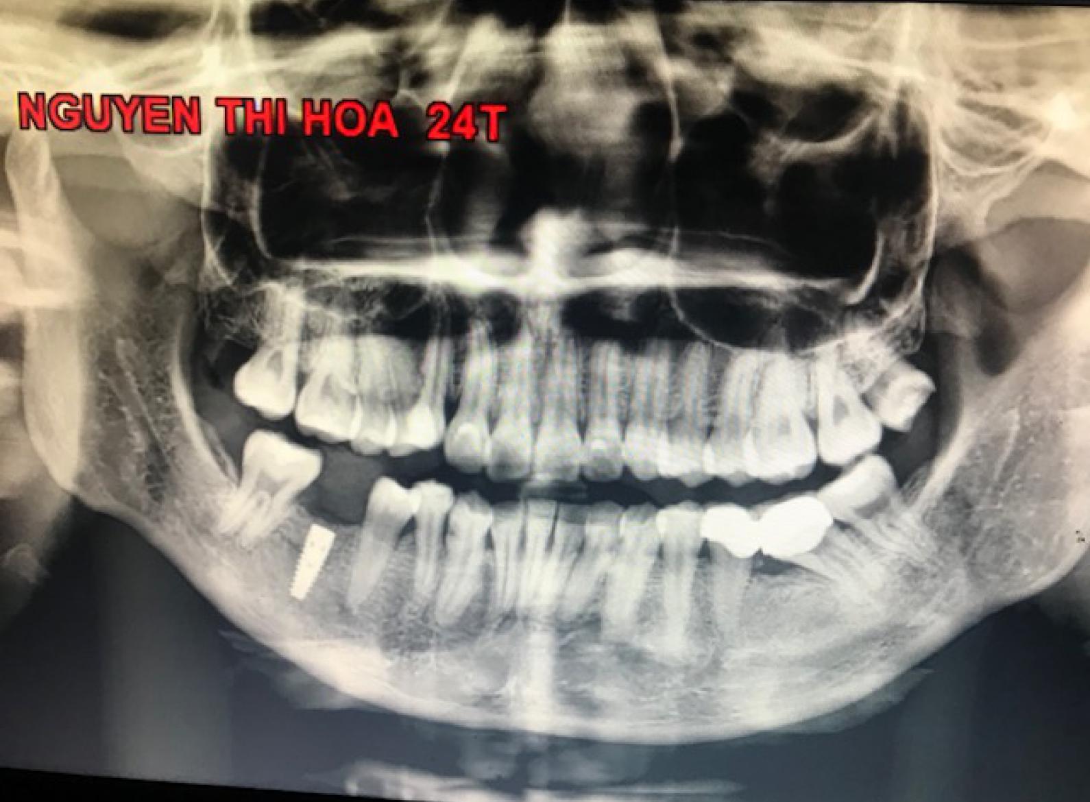 Cấy ghép nha khoa (Dental implant) tốt nhất