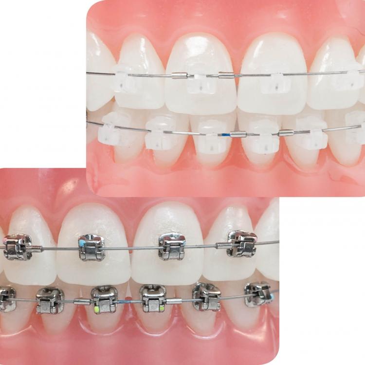 Niềng răng (Chỉnh nha) mắc cài